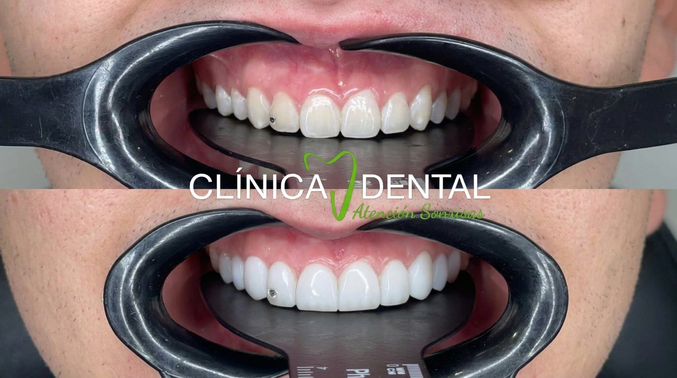 Clínica Dental Atención Sonrysas — resultados de diseño de sonrisa