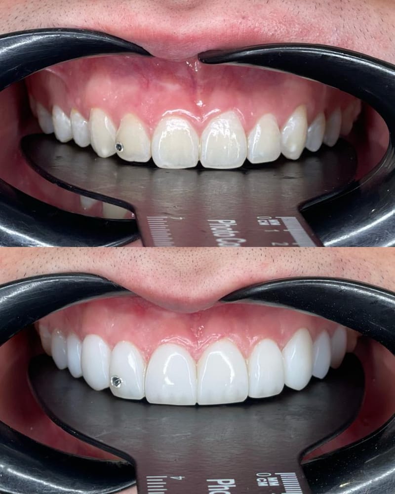 Diseño de Sonrisa — antes y después