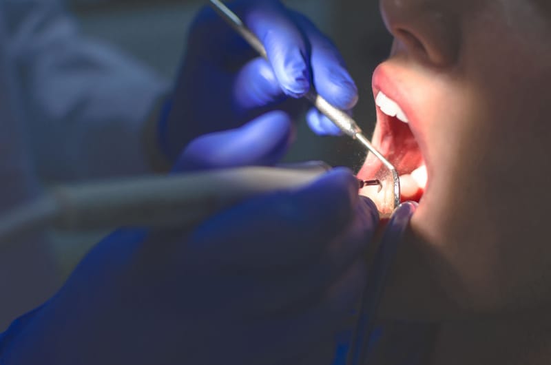 Extracciones dentales